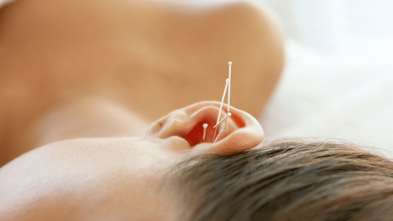 Frau mit Ohrakupunkturnadeln: Ohrakupunktur: Eine effektive Ergänzung zur ganzheitlichen Chiropraktik